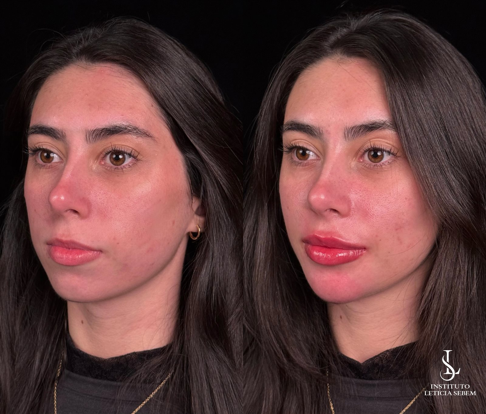 Antes e depois &ndash; preenchimento labial
