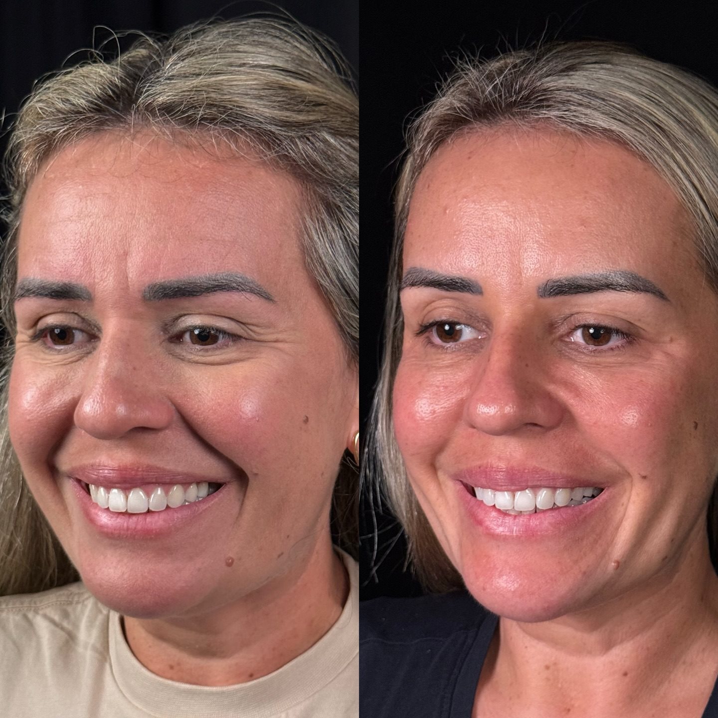 Antes e depois &ndash; harmonização natural