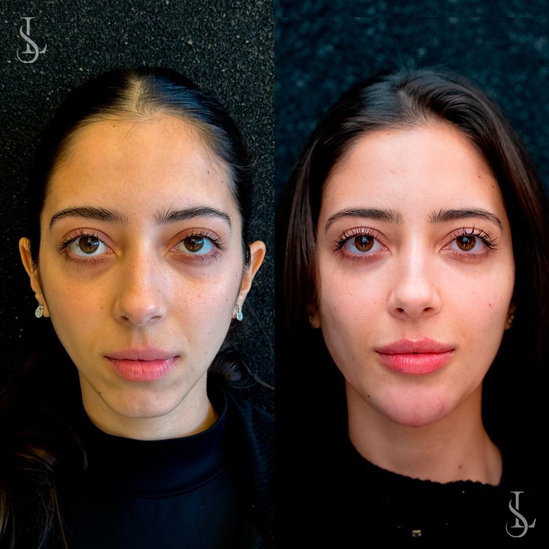 Antes e depois &ndash; olheiras