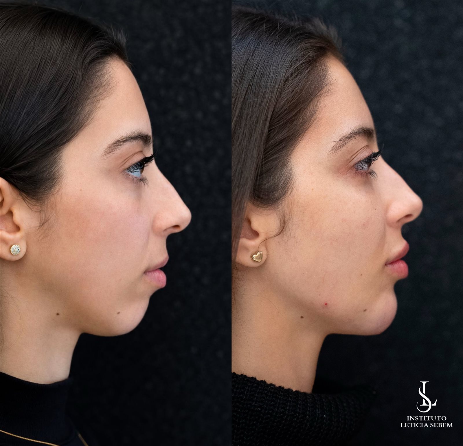 Antes e depois &ndash; perfil