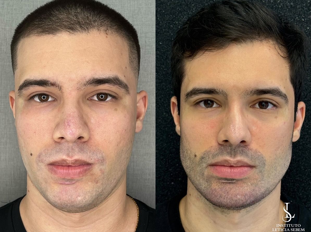 Antes e depois &ndash; harmonização facial