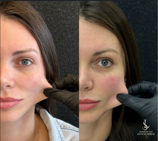 Antes e depois &ndash; bioestimulador de colágeno