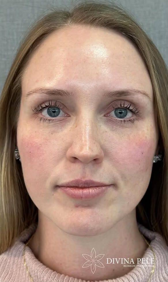 Botox