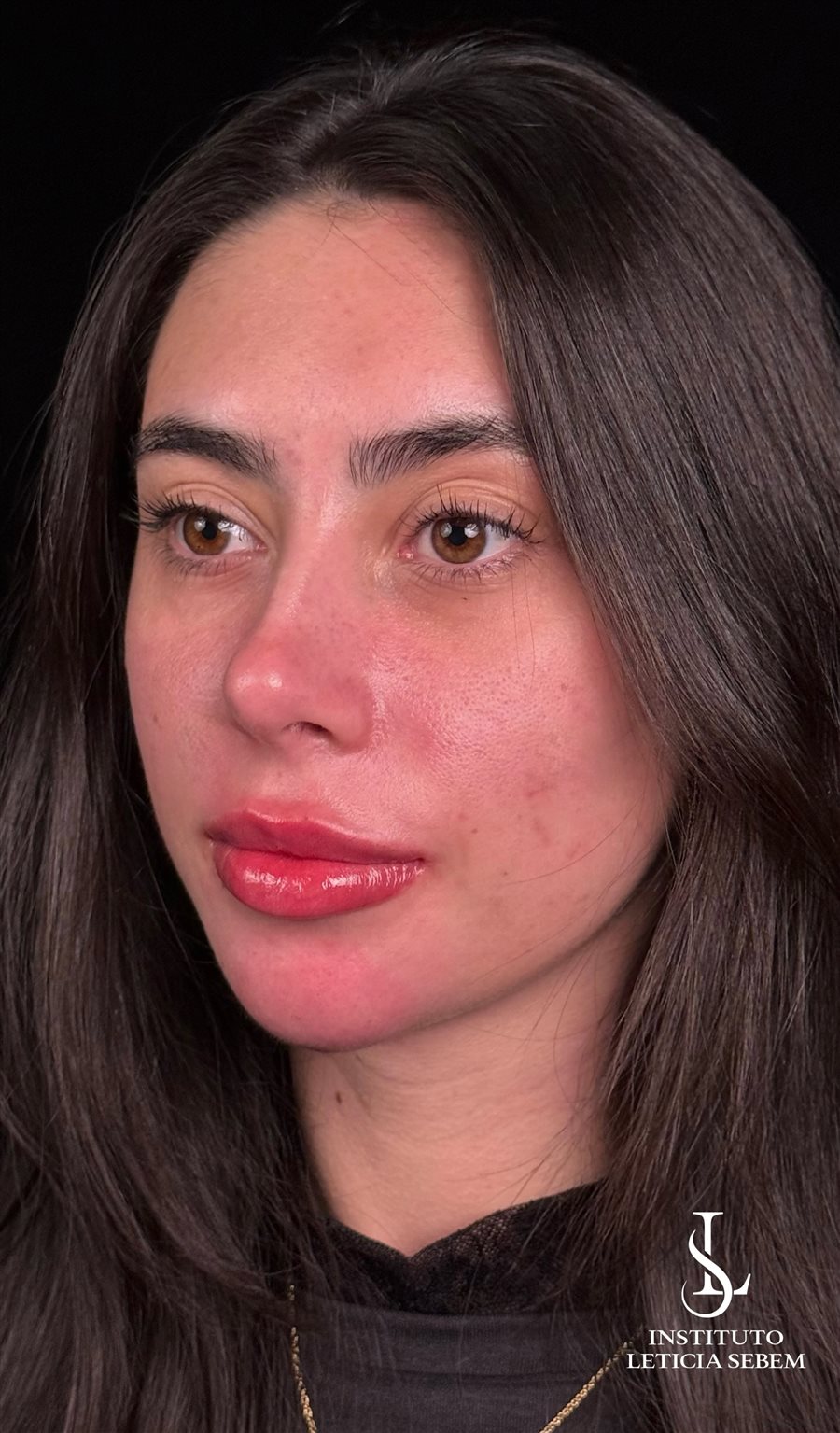 Harmonização Facial