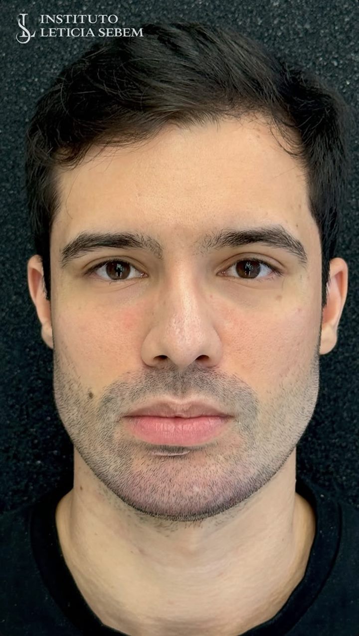 Harmonização Full Face