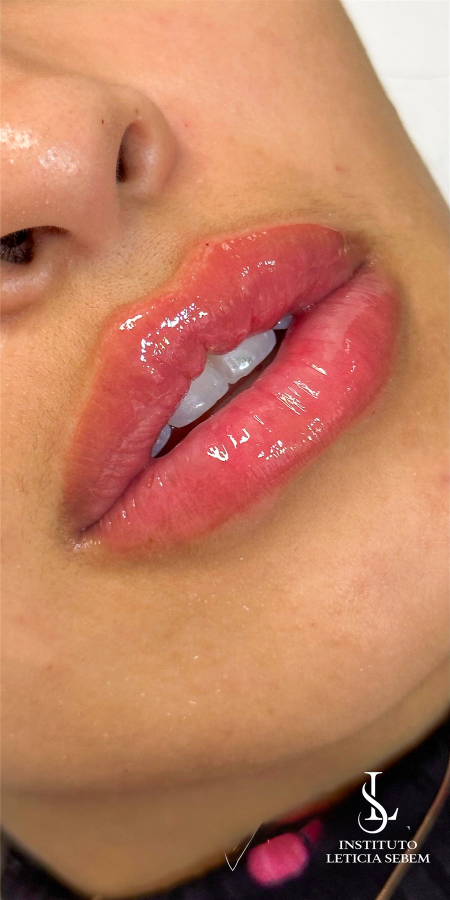 Preenchimento Labial